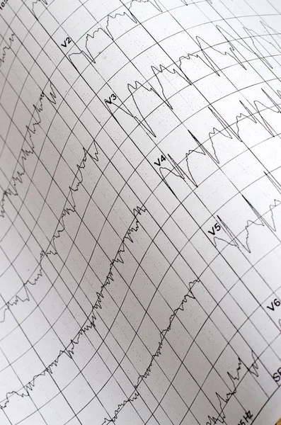 Ηλεκτροκαρδιογράφημα Γράφημα Ιατρικό Ιστορικό Κοντινό Πλάνο — Φωτογραφία Αρχείου