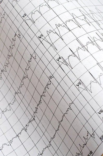 Ekg Diagram Orvosi Háttér Közelről — Stock Fotó