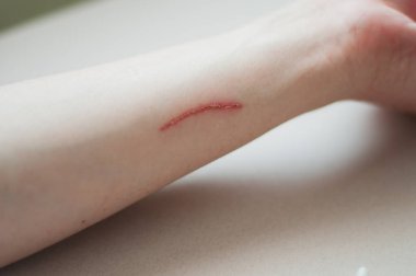 Kesik, yara tedavisi, yara için tıbbi aletler.