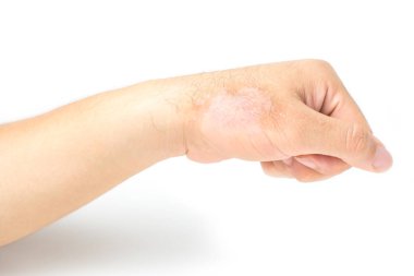Erkekler ellerini Kaşıntılı döküntüler tarafından dermatit neden nedeniyle çizik. Beyaz arka plan ve kırpma yolu izole.