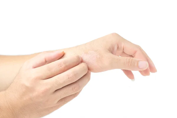 Men Hands Scratched Because Itchy Rashes Caused Dermatitis Isolated White — Stock Photo, Image