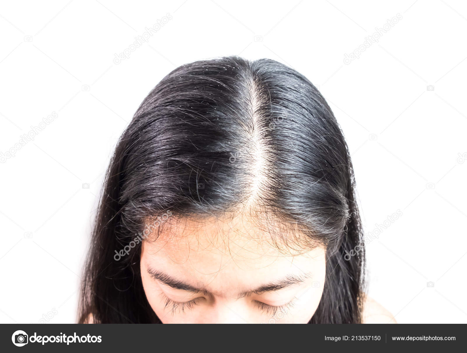 Women Head Dandruff Caused Problem Dirty Caused Skin Disease Seborrheic  Stock Photo by © 213537150