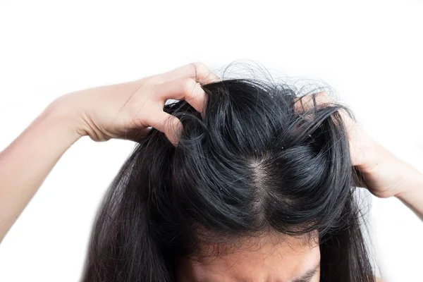 Women Head Dandruff Caused Problem Dirty Caused Skin Disease Seborrheic — Stock Photo, Image