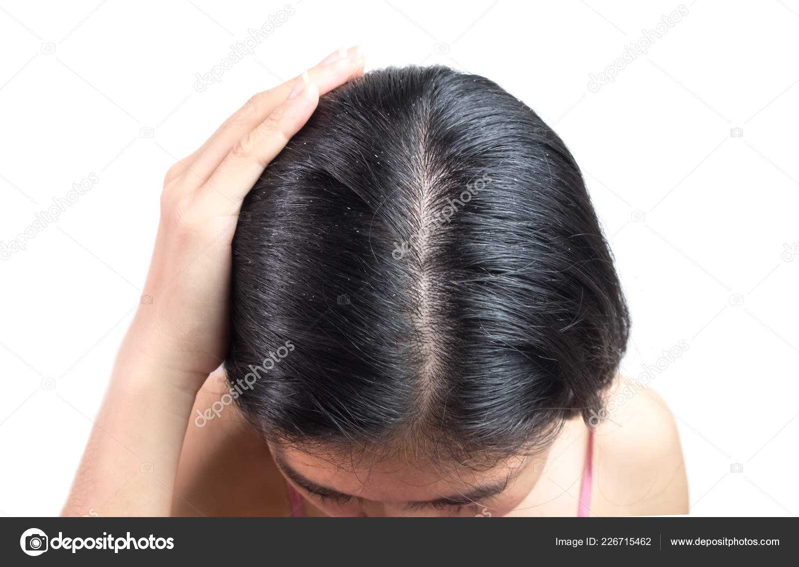 Women Head Dandruff Caused Problem Dirty Caused Skin Disease Seborrheic  Stock Photo by © 226715462