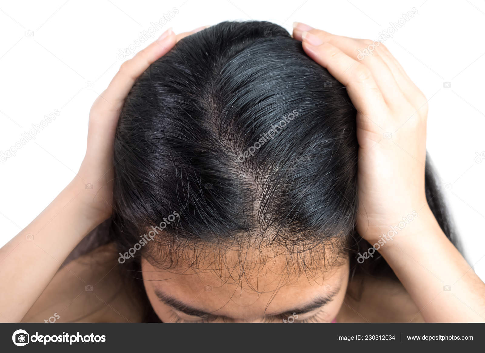 Women Head Dandruff Caused Problem Dirty Caused Skin Disease