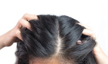 kepek neden kirli sorunu tarafından birlikte kadınlar kafa. Ya da deri hastalığı ya da Seboreik dermatit tarafından nedeniyle. O beyaz pullu ve kaşıntı neden olur.