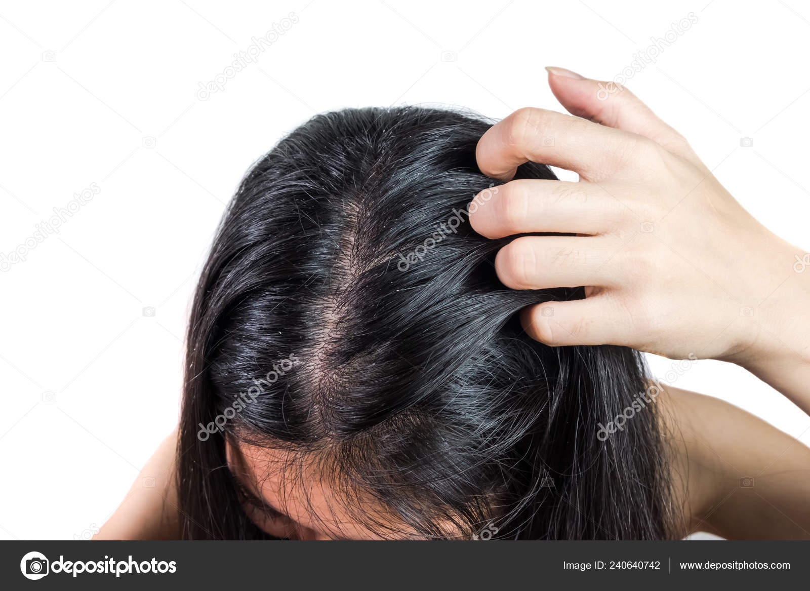 Women Head Dandruff Caused Problem Dirty Caused Skin Disease