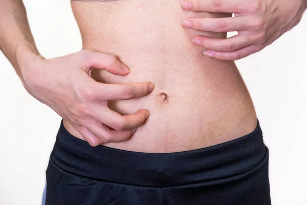 Girl Who Caused Itching Body Allergies Skin Disease Caused Fungus — Stock Photo, Image