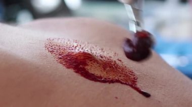 Ambar ameliyatı için lipoma temizliği.