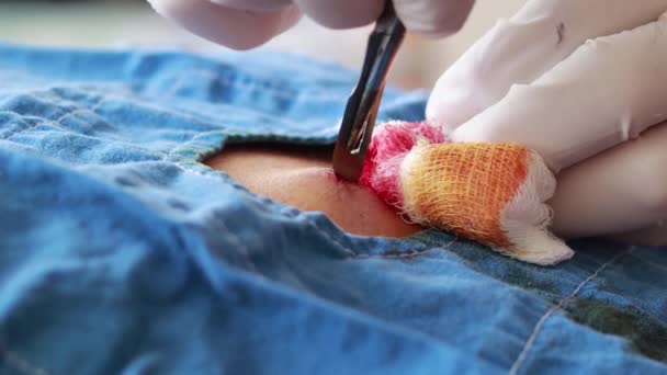 Різання Шкіри Спині Людини Амбулаторної Хірургії Вибірковому Фокусі — стокове відео