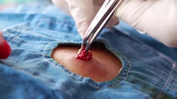 Estrarre Lipoma Nella Schiena Dell Uomo Chirurgia Ambulatoriale Fuoco Selettivo — Video Stock