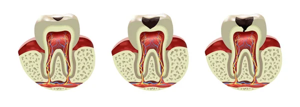 Human Tooth Decay Disease Cross Section Realistic View Vector Illustration — Stock Vector