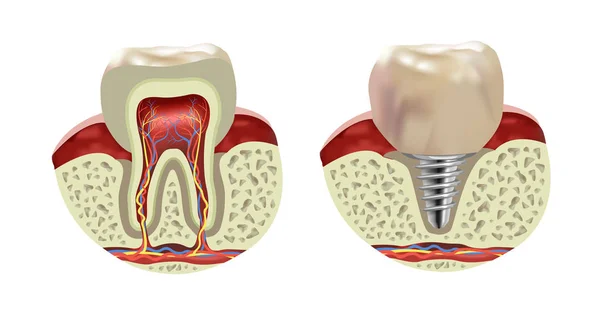 Штучний Імплантат Зубів Людини Перетин Реалістичний Вид Векторні Ілюстрації — стоковий вектор
