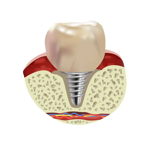 Штучний Імплантат Зубів Людини Перетин Реалістичний Вид Векторні Ілюстрації — стоковий вектор