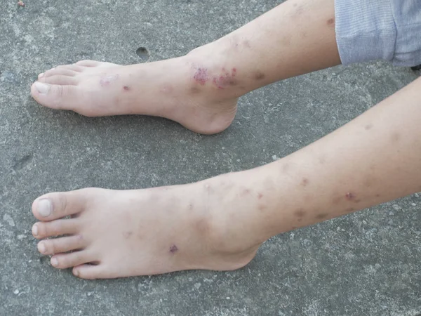 Close up image of itchy scratched wounded feet — Stock Photo, Image