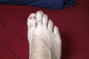 Dar ayakkabı giyen hasarlı çivi ile adamın ayağının ön