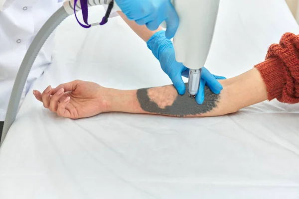 laser tattoo removal on woman\'s arm