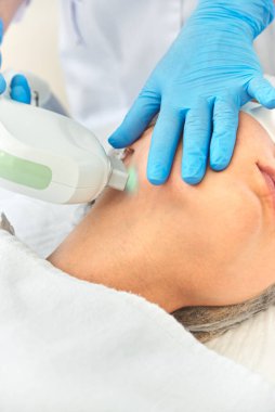 Kadınlarda lazer yüz tazeleme