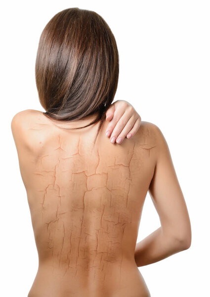 Woman with cracked on back as cosmetic and dehydration effect concept.