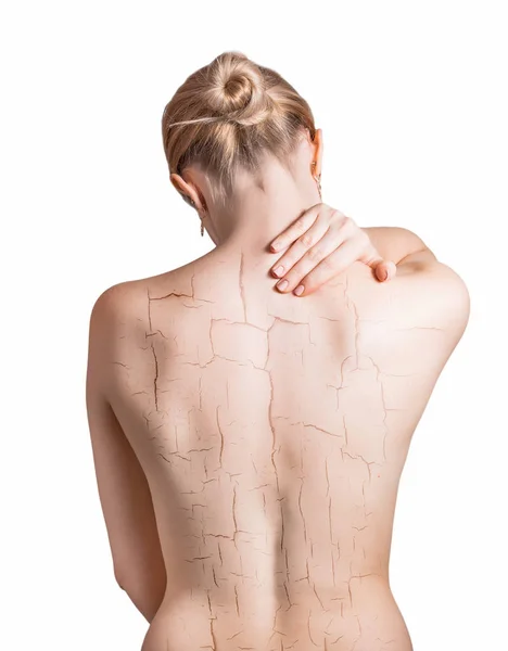 Woman Cracked Back Cosmetic Dehydration Effect Concept — Stock Photo, Image