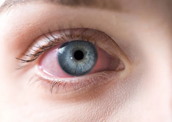 赤い女性の目のマクロ 血中眼 結膜炎またはアレルギー反応 — ストック写真