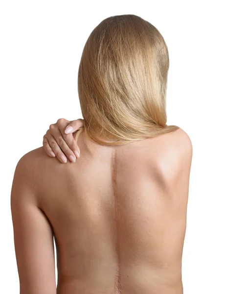 Mujer Joven Con Cicatrices Cirugía Espinal — Foto de Stock