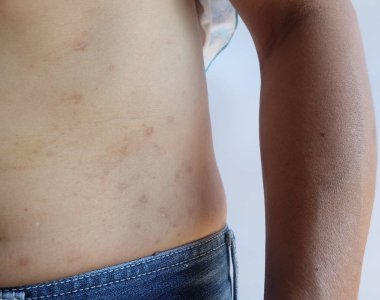 Beyaz arka plan üzerinde cilt vücudunda atopik dermatit