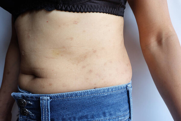 Atopic dermatitis on skin body on white background