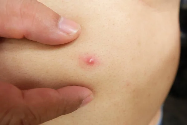 Mani Stanno Premendo Acne Brufolo Sul Corpo — Foto Stock