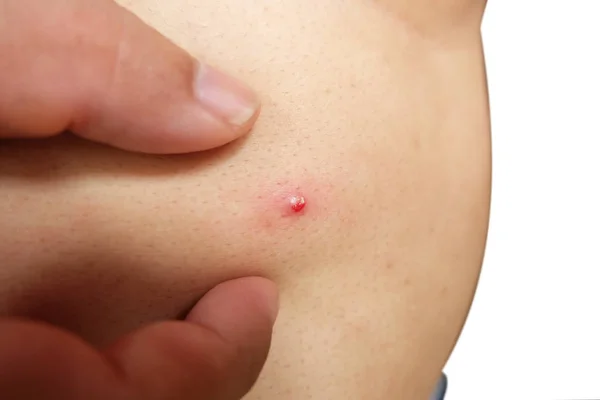 Mani Stanno Premendo Acne Brufolo Sul Corpo — Foto Stock