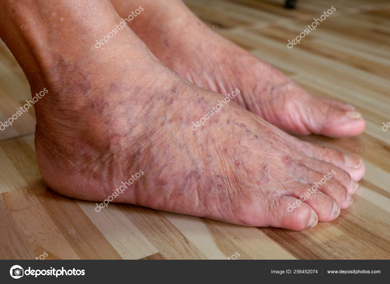 foto varicose foot