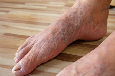 Bir Asyalı yaşlı kadının bacaklar ve ayakları üzerinde varis yakın