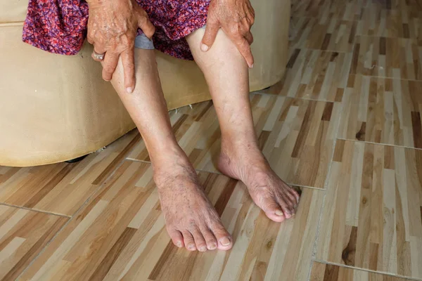 Asyalı Yaşlı Kadın Bacaklar Ayaklar Varisli Damarlardan Bir Bacak Ağrı — Stok fotoğraf