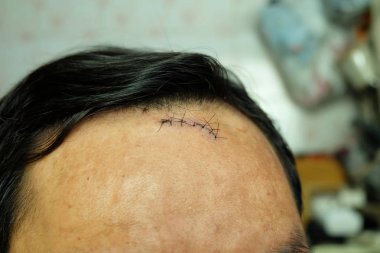Suture sewn seven stitches on the head from accident, head injury, Selective focus. clipart