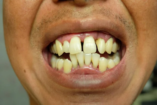 Zbliżenie Krzywe Żółte Zęby Mężczyzn Dziąseł Zębów Które Muszą Być — Zdjęcie stockowe