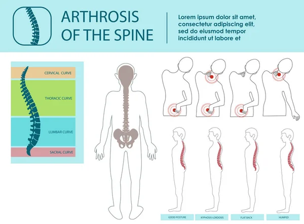 Artrosi della colonna vertebrale. Illustrazione vettoriale . — Vettoriale Stock
