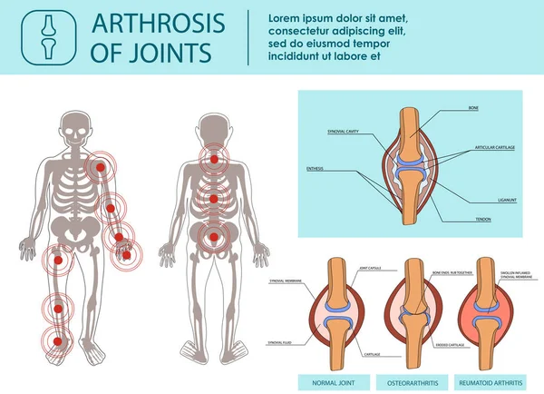Artrosi delle articolazioni. Illustrazione vettoriale . — Vettoriale Stock