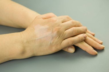 Vitiligo gri bir arka planda.