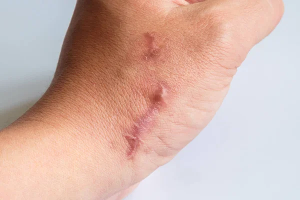 The scar on his arm near the wrist on a white background. Two scars next to each other on the arm, close-up. Not isolated. — Stock Photo, Image