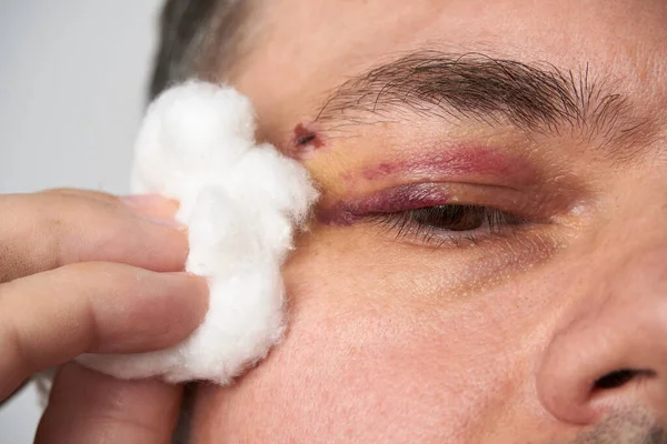 Close View Bruise Eye Face Man Hematoma — Stock Photo, Image