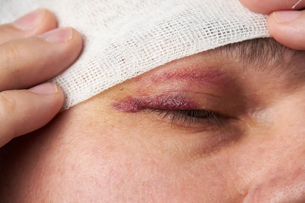 Close View Bruise Eye Face Man Hematoma — Stock Photo, Image