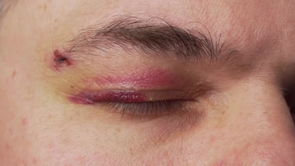 Close View Bruise Eye Face Man Hematoma — Stock Video