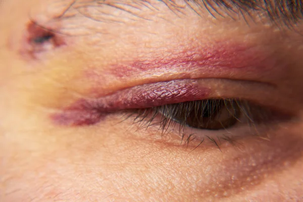 close view of a bruise near the eye, the face of a man with a hematoma