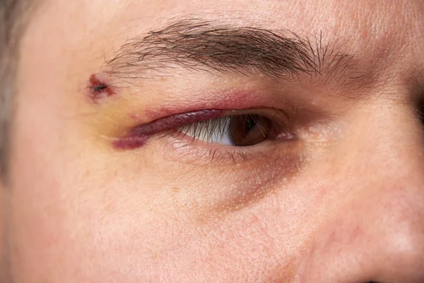 close view of a bruise near the eye, the face of a man with a hematoma