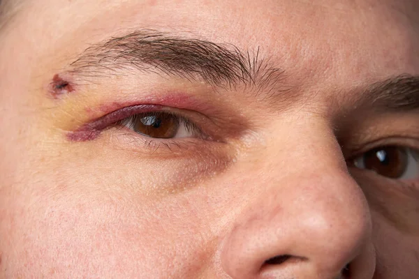 Close View Bruise Eye Face Man Hematoma — Stock Photo, Image