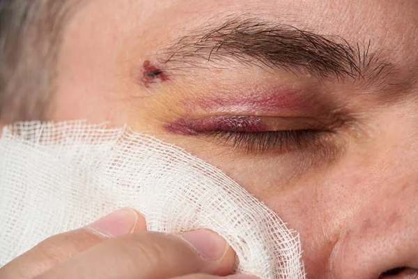 Close View Bruise Eye Face Man Hematoma — Stock Photo, Image