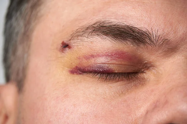 Close View Bruise Eye Face Man Hematoma — Stock Photo, Image