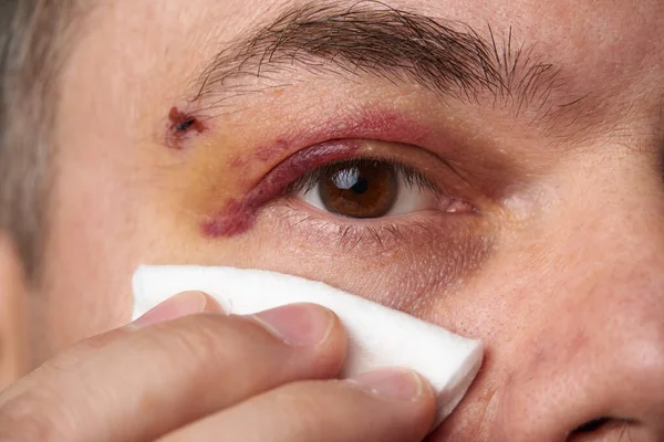 Close View Bruise Eye Face Man Hematoma — Stock Photo, Image