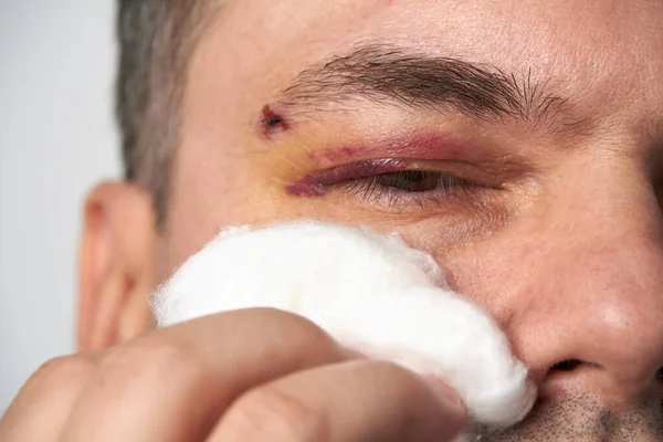 Close View Bruise Eye Face Man Hematoma — Stock Photo, Image