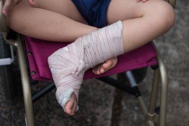 Kaza çocuk çocuk tekerlekli sandalye üzerinde oturan. Kırık bacak alçı ve oklüzal splint tarafından sarılmış. Sağlık ve sigorta için çocuk kavramı.